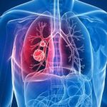 Cáncer de pulmón - DeboSaber.cl