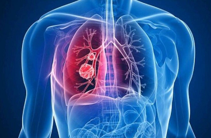Cáncer de pulmón - DeboSaber.cl