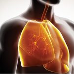 Hipertensión Arterial Pulmonar