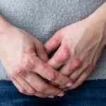 Psoriasis