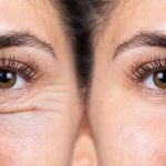 Blefaroplastia