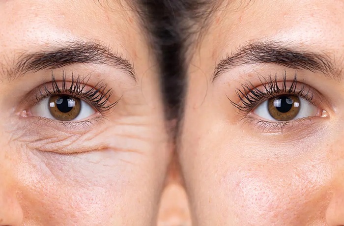 Blefaroplastia