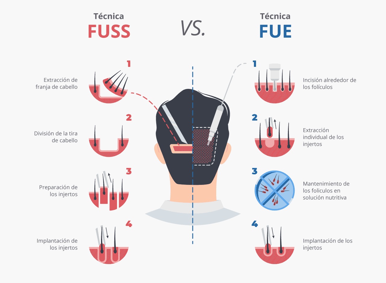 FUSS vs. FUE FUSS vs. FUE