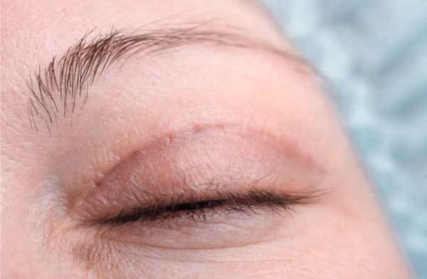 blefaroplastia post operatorio blefaroplastia post operatorio