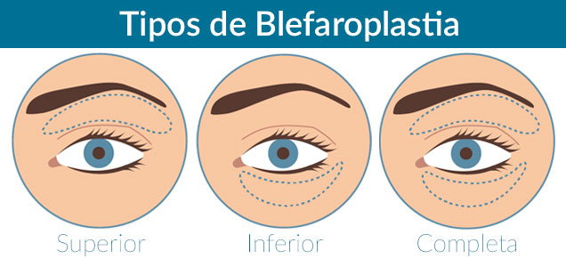 tipos de blefaroplastia tipos de blefaroplastia