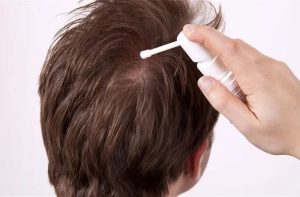 Aplicacion de minoxidil