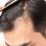 Minoxidil para la caida del cabello