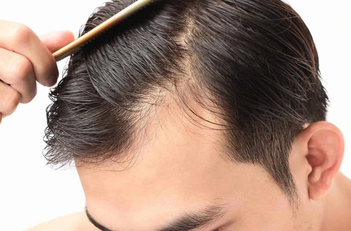 Minoxidil para la caida del cabello
