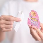 Tratamiento cáncer de pulmón