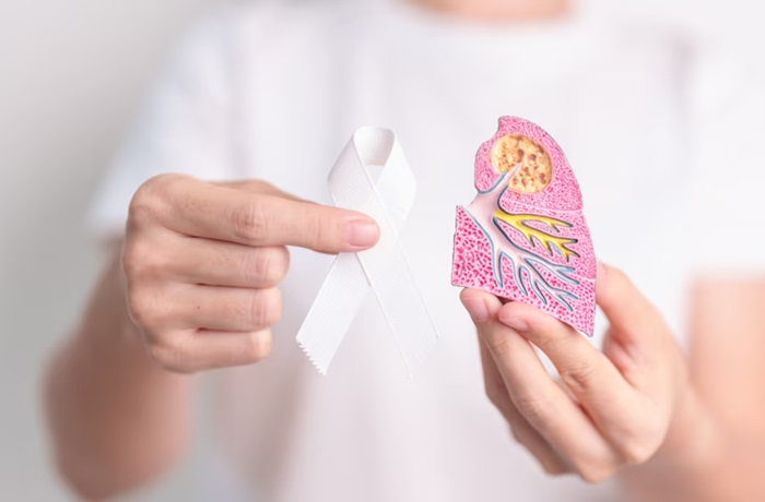 Tratamiento cáncer de pulmón