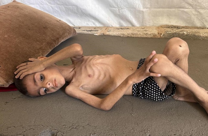 Hambruna en Gaza
